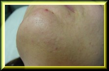 fotografia luego del tratamiento